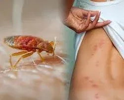 gaps in bed bug bites