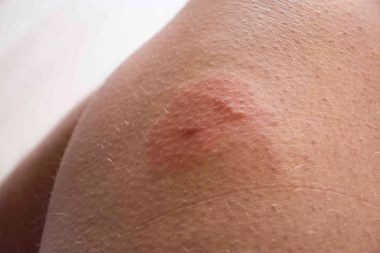 Bites on Arms and Shoulders
