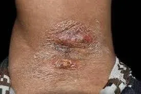 How Long Does a Bug Bite Infection Last