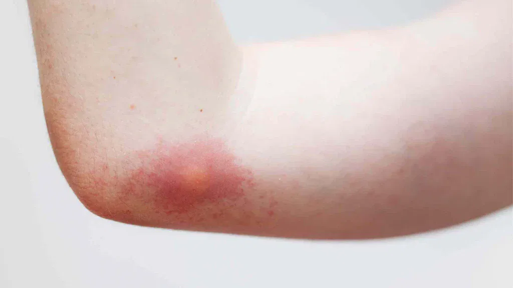 large local reaction to wasp sting treatment