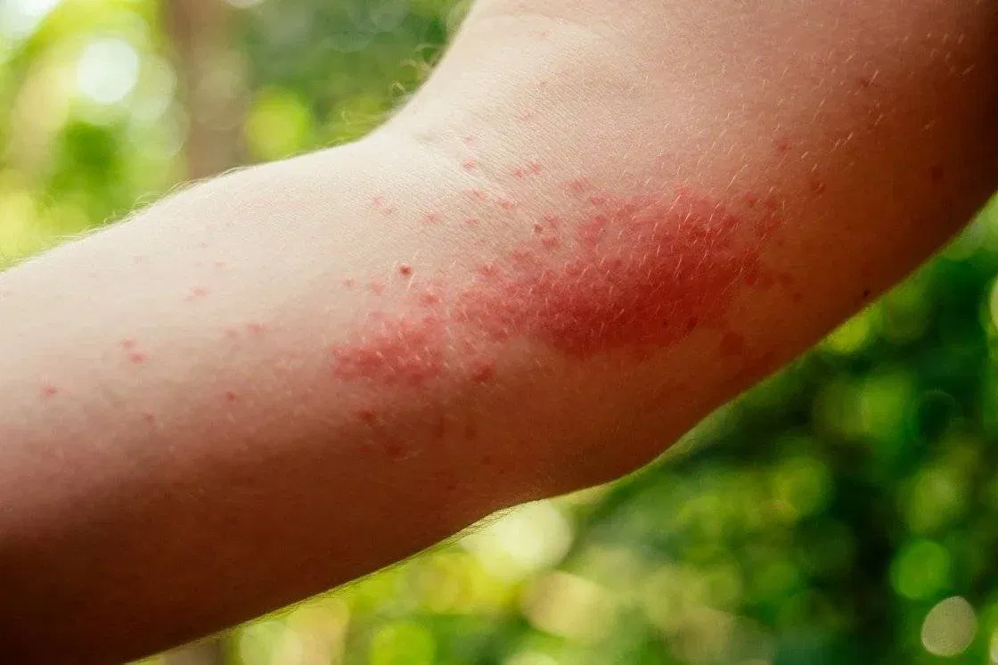 natural remedies for spider bite