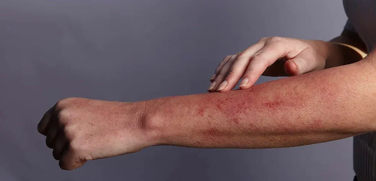 Poison Ivy Rash vs Spider Bite