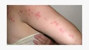 Random Painful Bites on Body