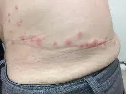 Red Bites Under Clothing Waistband
