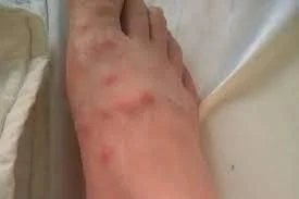 Red Spots on Skin That Look Like Bites But Aren't