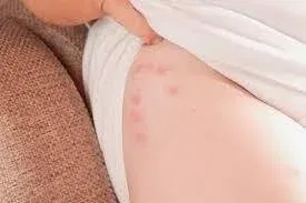 Scabies vs Bed Bug Bites