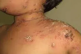 Secondary Skin Infection From Scratching