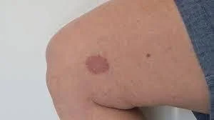 Spider Bites That Look Like a Bruise