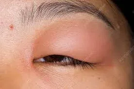 swollen eyelid from bug bite