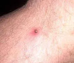 Symptoms of Tick-Borne Illness