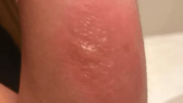 tiny blisters after spider bite