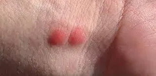Tiny Red Bites That Disappear Quickly