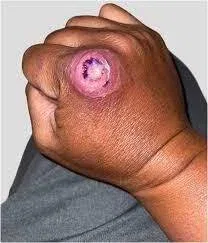 Tularemia from Deer Fly Bite