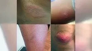 Lone Star Tick Bite Symptoms & Rash