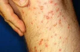 fire ant bites on toddler 1