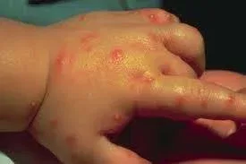 fire ant bites on toddler