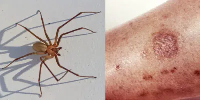 Brown Recluse Bite Remedy