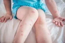 How to Heal Mosquito Bite Scars
