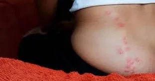 bug bites in a straight line