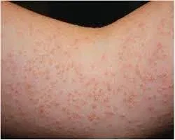 Mysterious Itchy Bumps on Vacation
