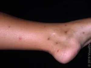 Folliculitis vs Bug Bites on Legs