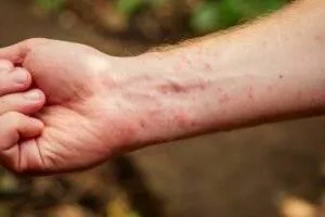 Stop Bug Bite from Itching Immediately