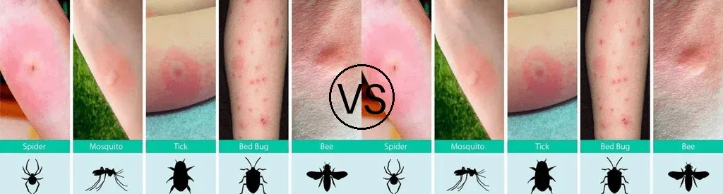 Flea Bites vs Bed Bug Bites