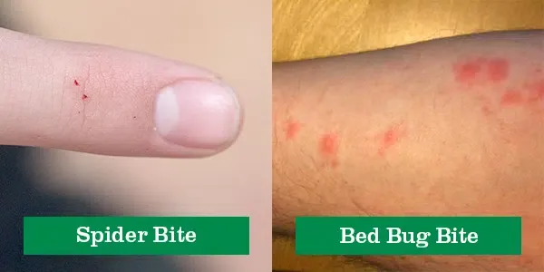 Spider Bite Vs Bed Bug Bite Png