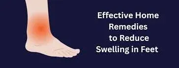 10 Powerful Home Remedies for Swelling