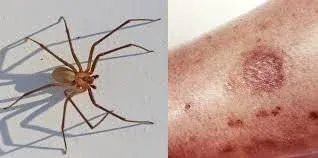 Antibiotics for Spider Bites