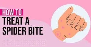 Home Remedies for Spider Bites