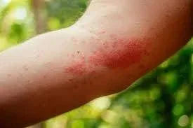 How to Stay Healthy After Insect Bites