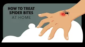 How to Treat a Spider Bite