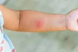 Signs of Dangerous Spider Bite