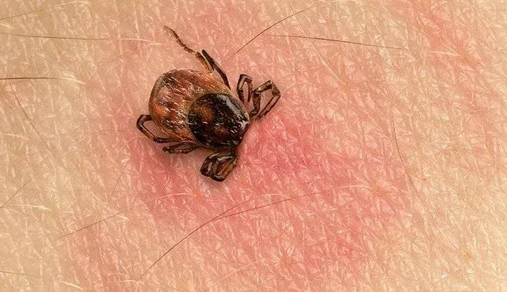 Tick Bite Symptoms to Watch