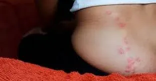 bug bites in a straight line