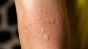 Bug Bites in a Straight Line