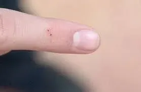 take child to doctor for spider bite