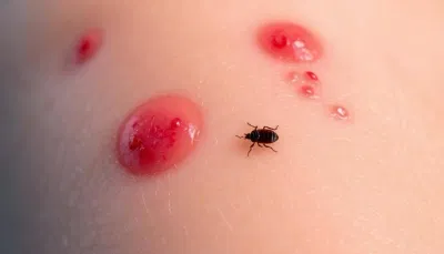 Bed Bug Flea Bites: Identify and Treat