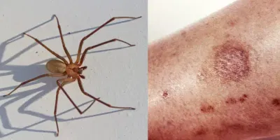 Brown Recluse Bite Remedy