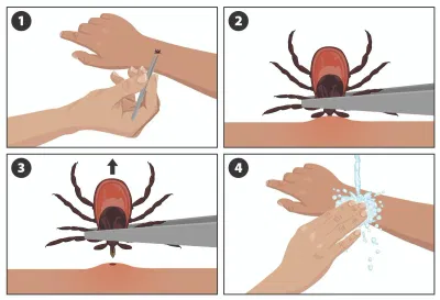 How to Remove Ticks Safely