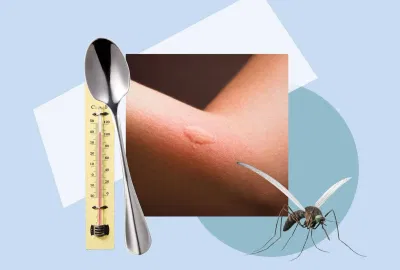 Ice or Heat for Mosquito Bites