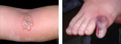 Spider Bite Symptoms and Treatment