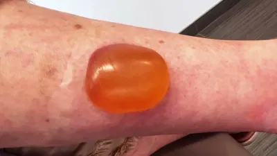Mosquito Bite Blister Treatment