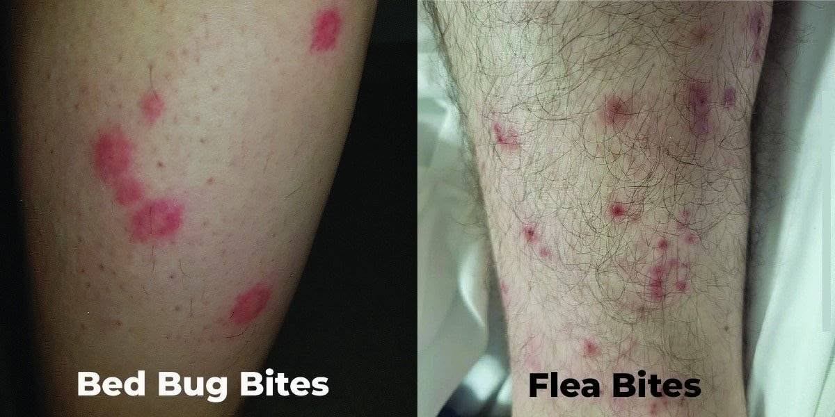 Bed Bug Bite vs Flea Bite