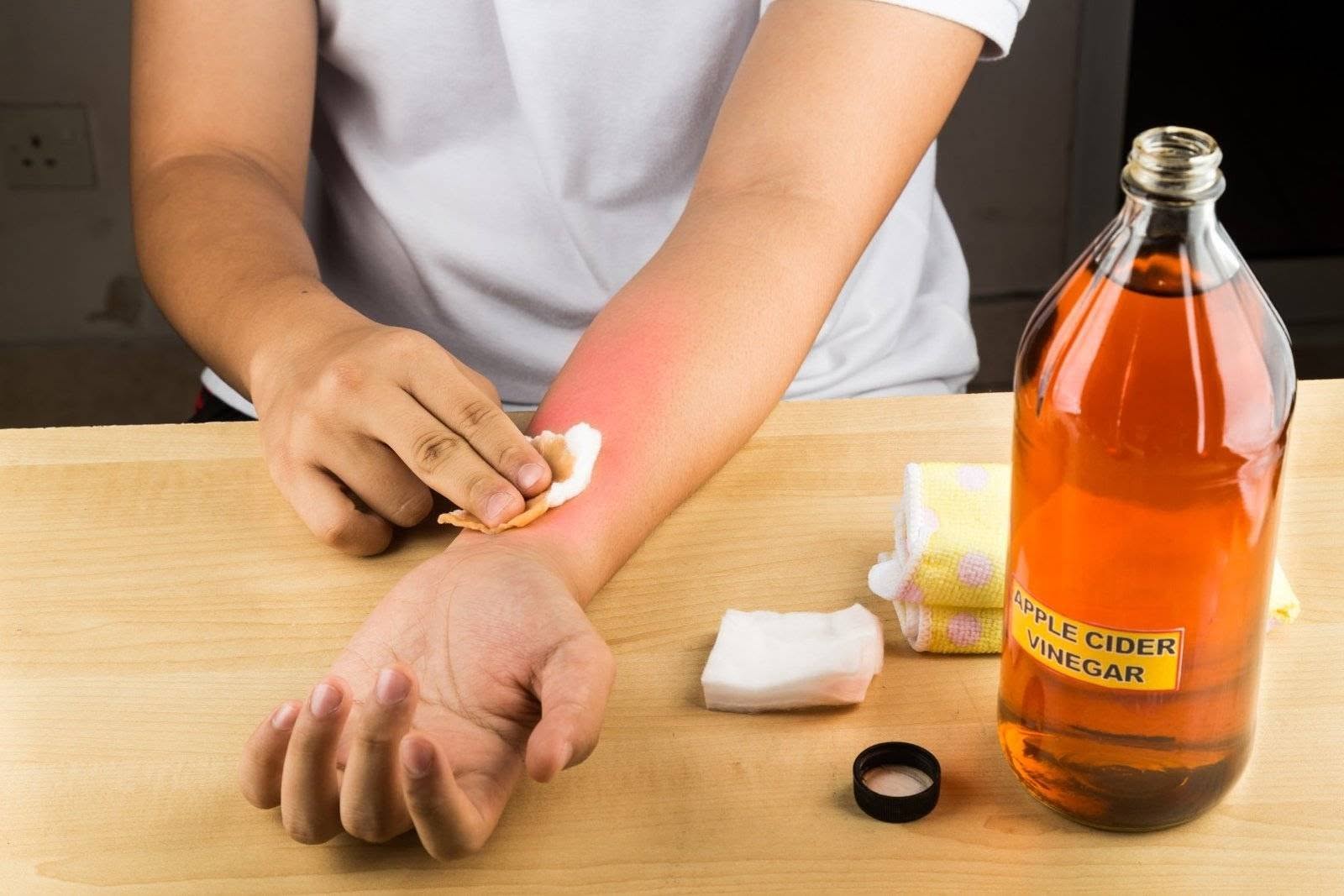Itching Relief Natural Solutions