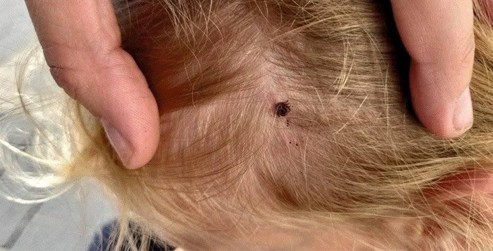 Where Do Ticks Usually Bite