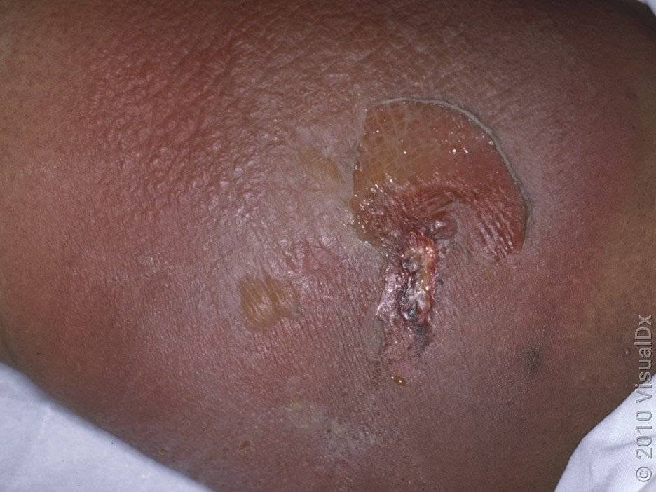 Can Spider Bites Cause Infections