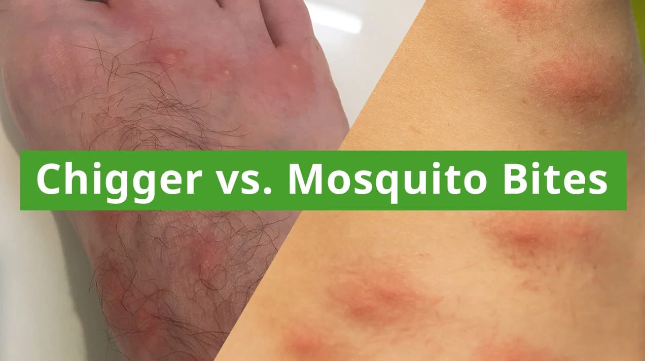 chigger bites vs mosquito bites