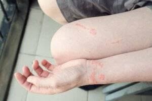 Brown Recluse Bite Symptoms Stages